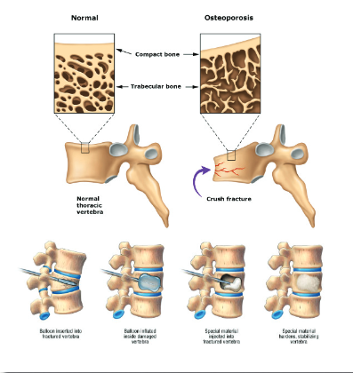 Fracturas por compresión de la columna vertebral