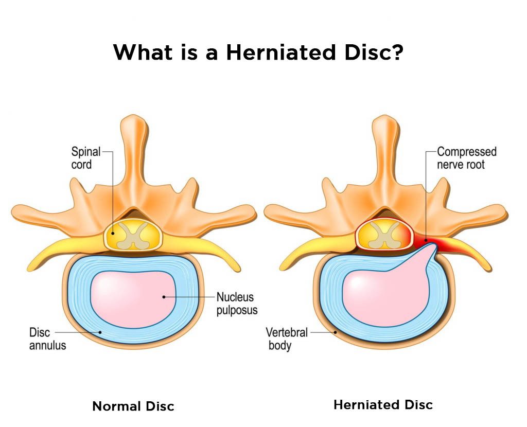 Discos normales y herniados